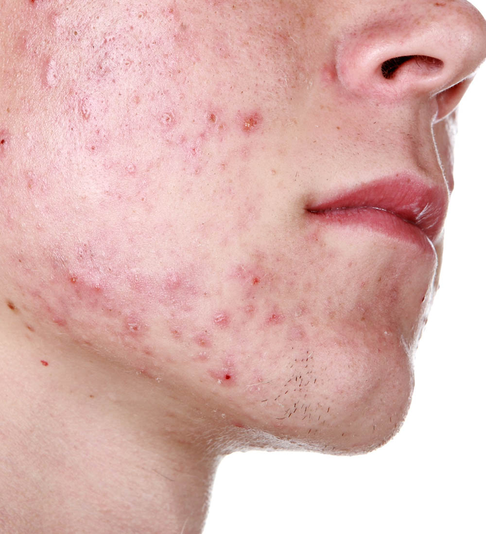Acne
