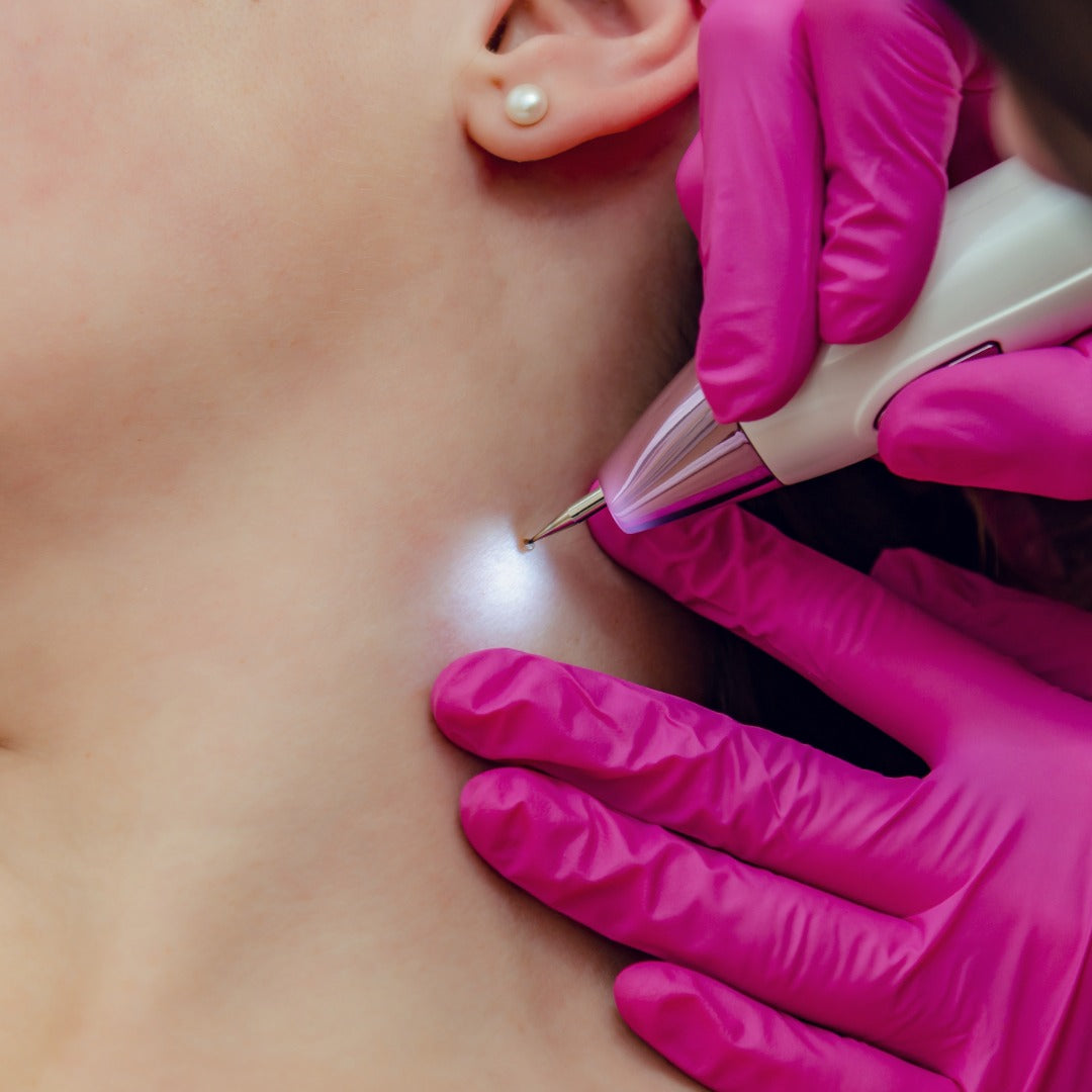 Skin Tag Removal