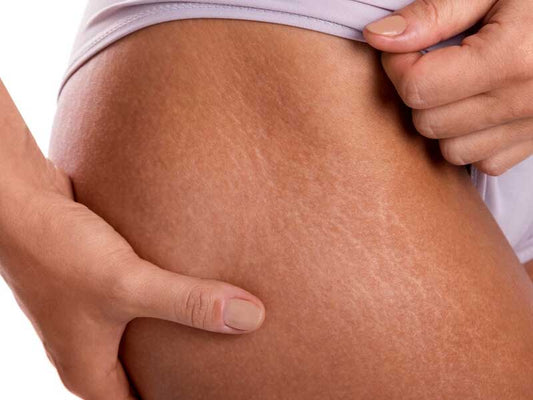 Stretch Mark Removal