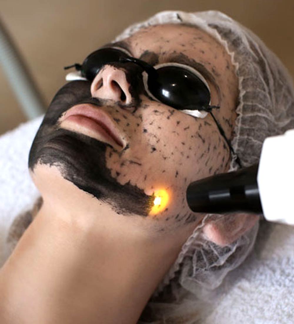 Carbon Peel Laser Facial