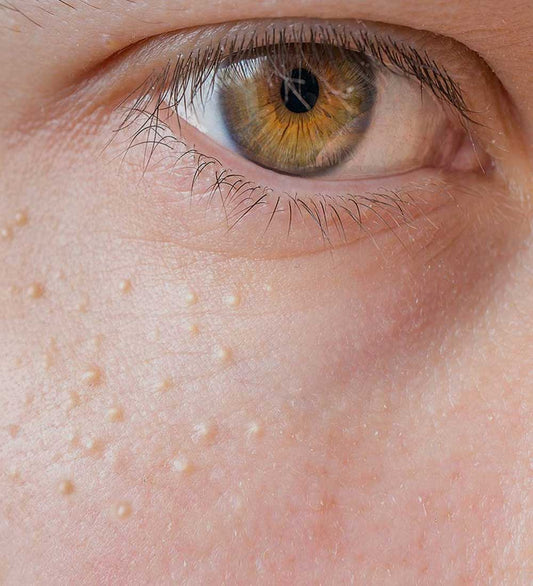 Milia Removal