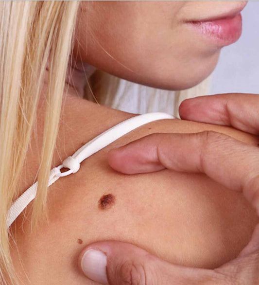 Mole Removal