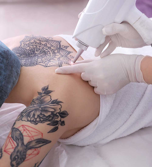 Laser Tattoo Removal