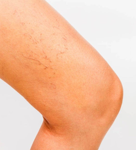 Thread Vein Removal