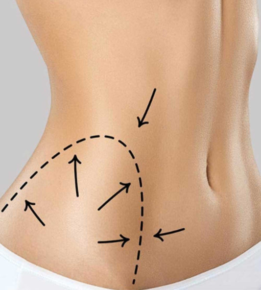 Smart Sculpt Body Contouring