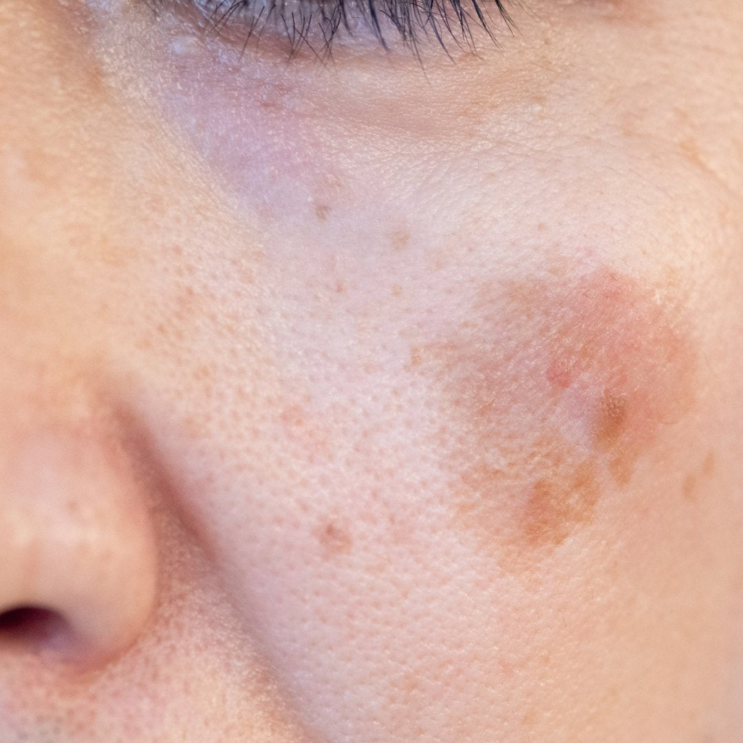 Age Spot Removal