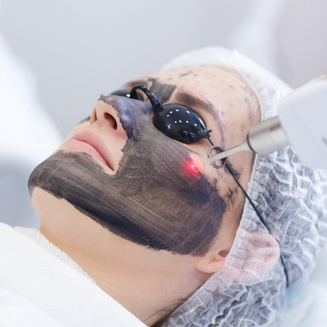 Carbon Peel Laser Facial
