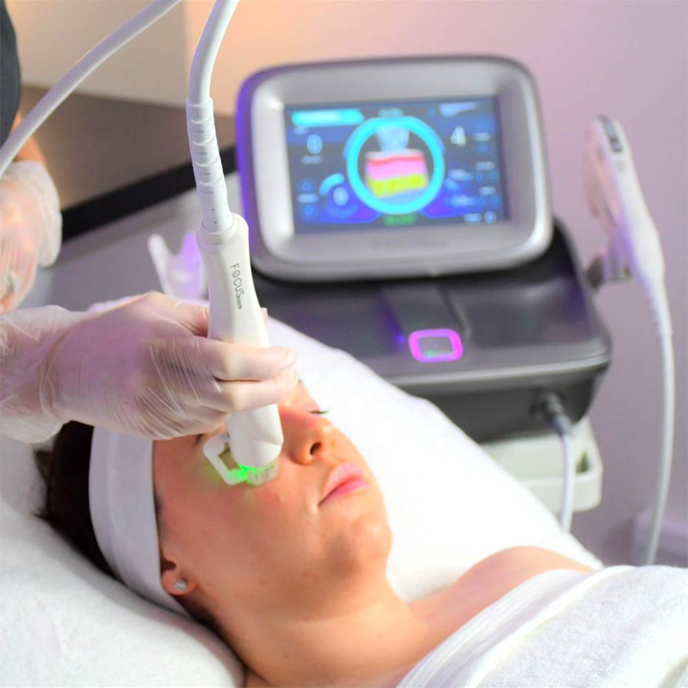 Radio Frequency Micro Needling Face (Focus Dual)