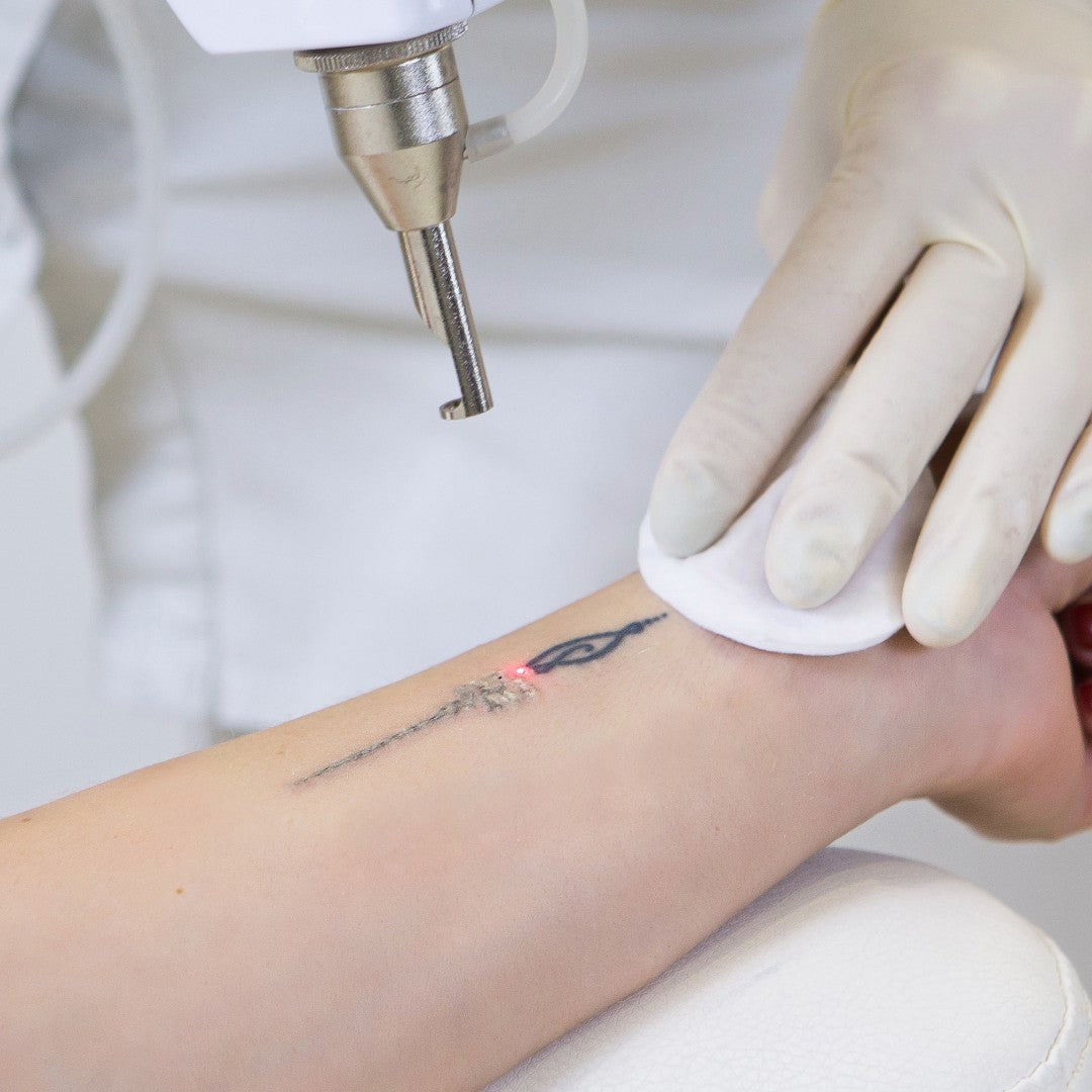 Laser Tattoo Removal