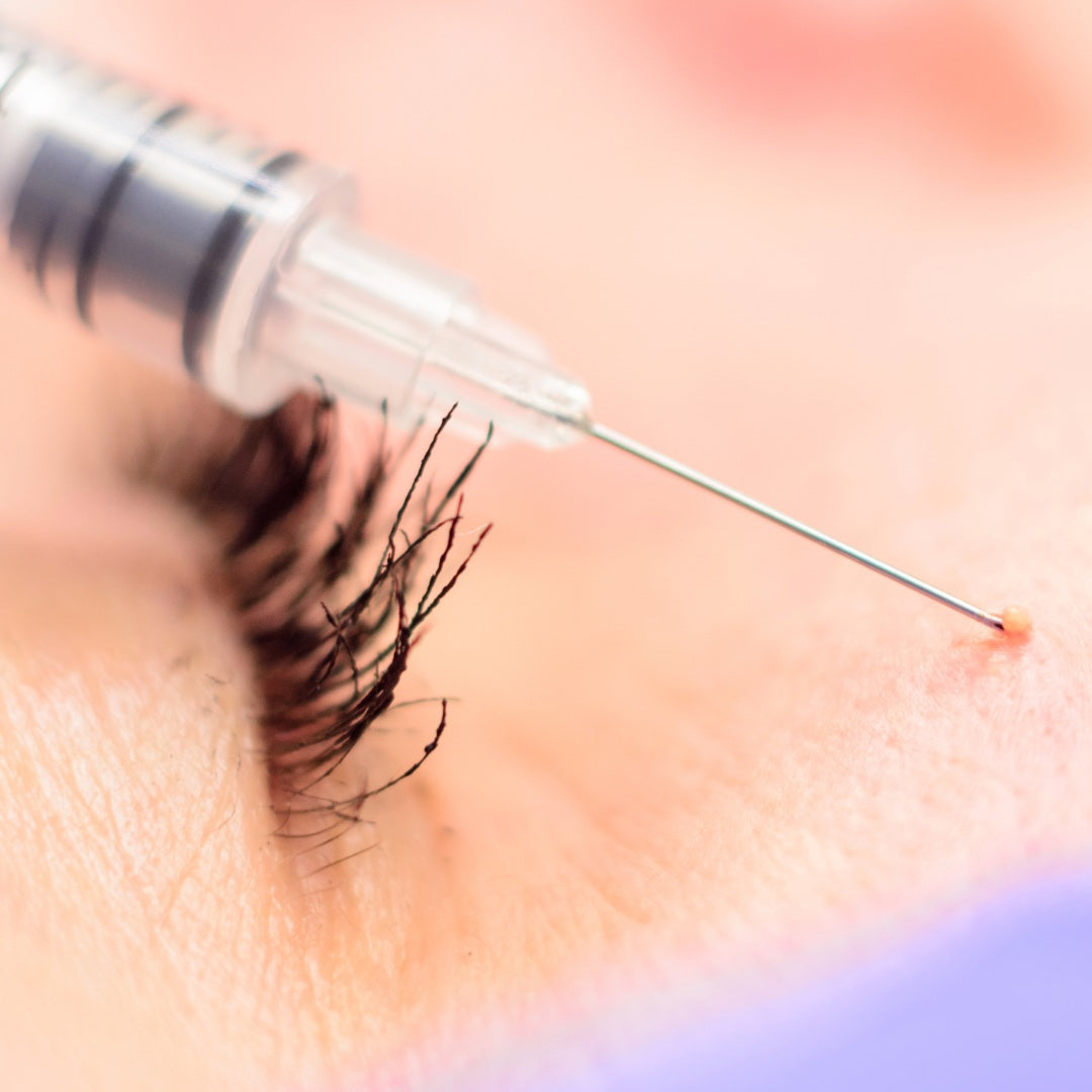 Milia Removal