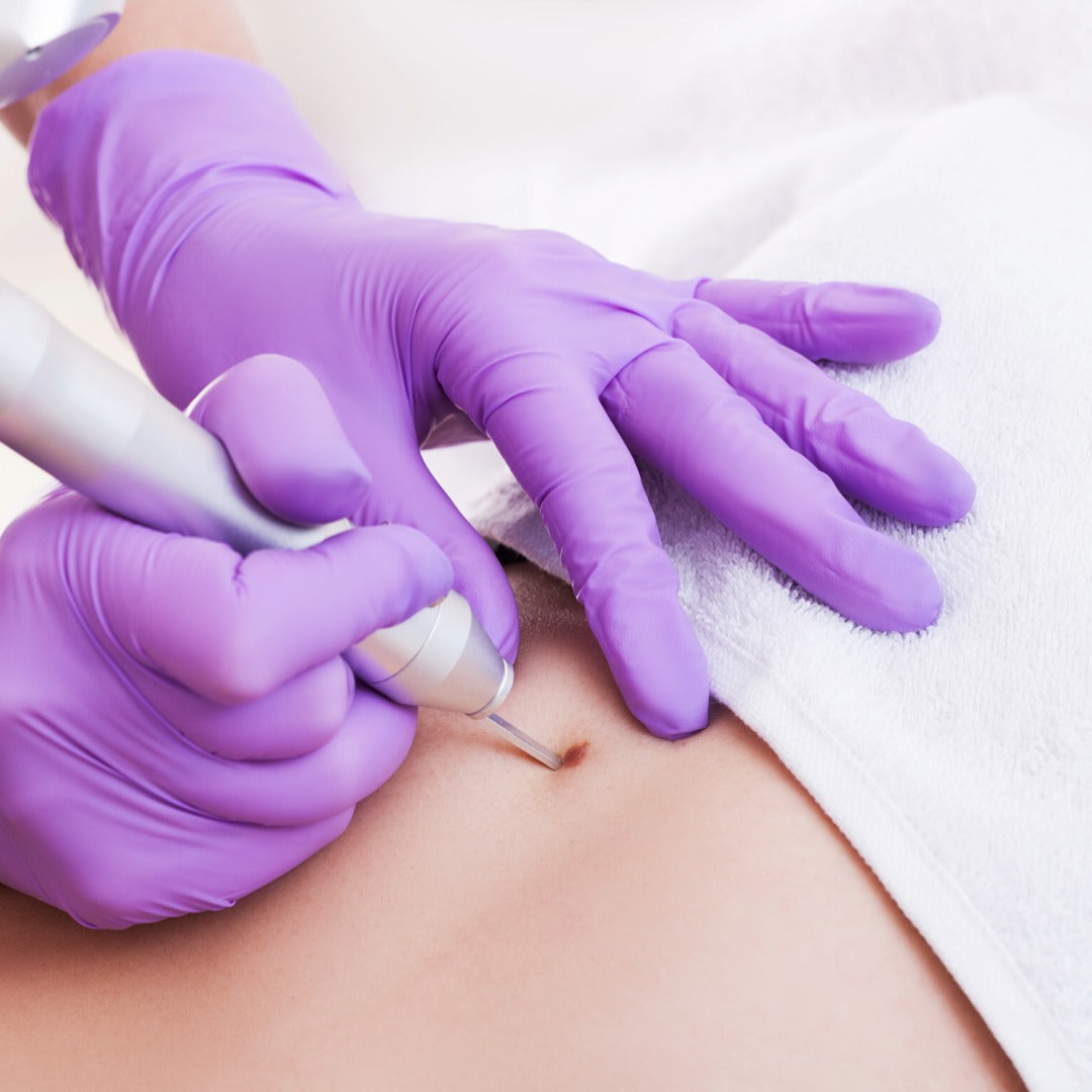 Mole Removal