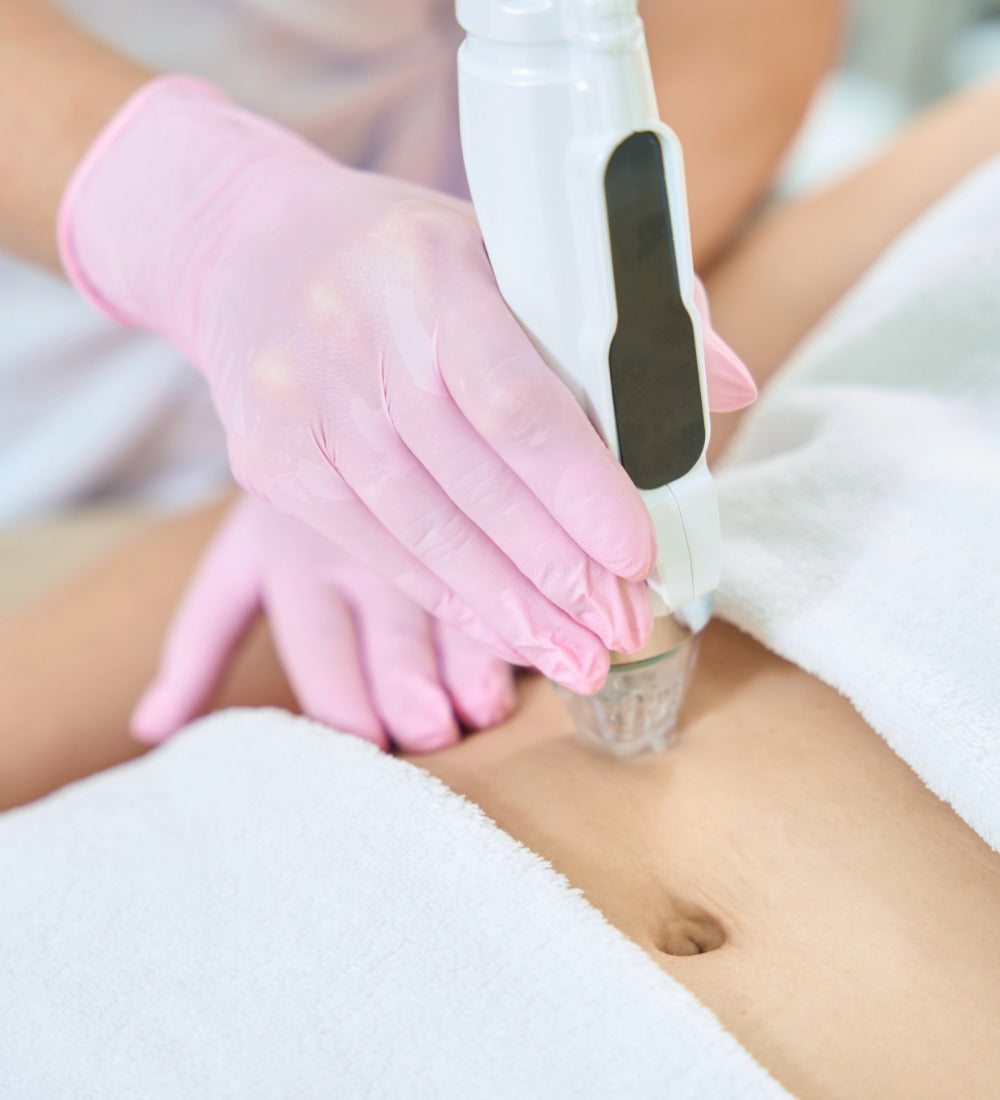 Radiofrequency Microneedling Body