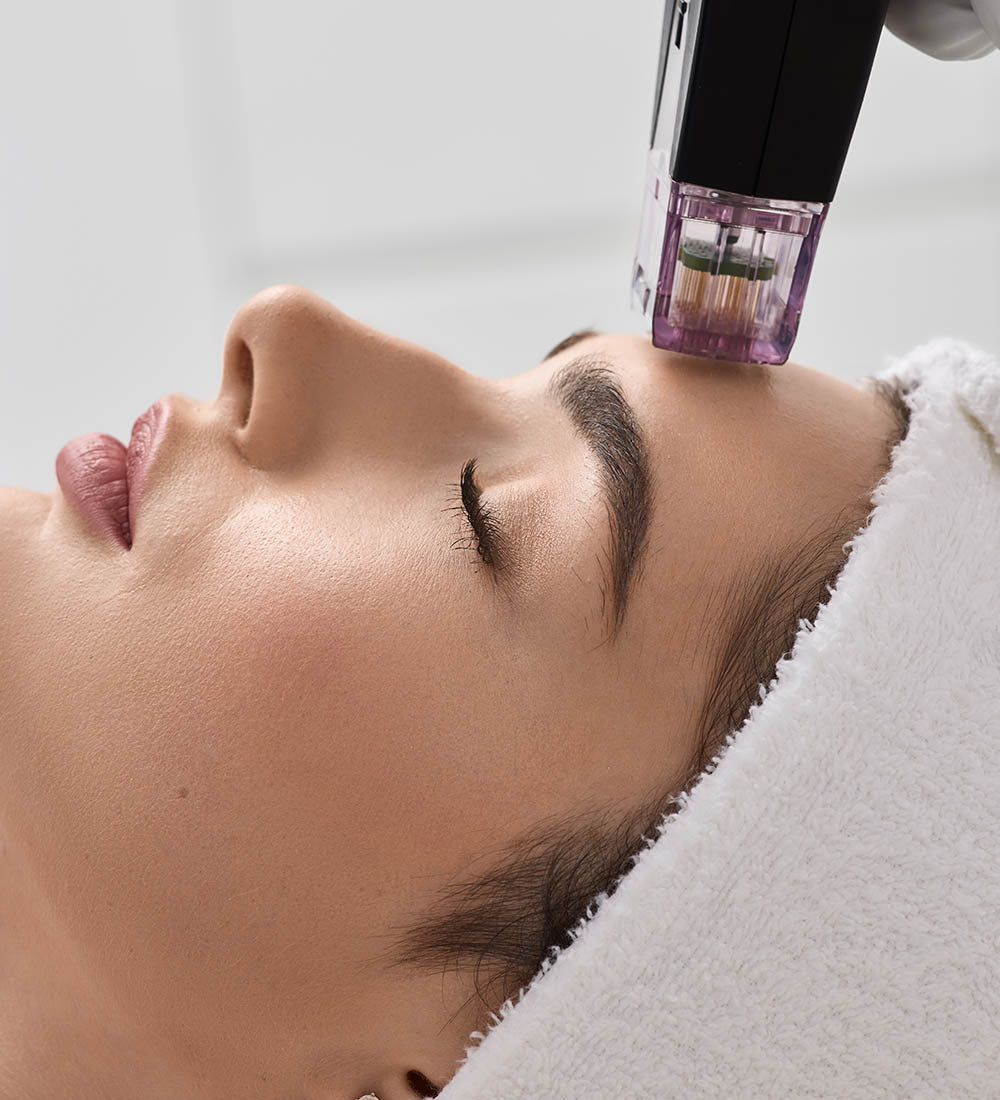 Radiofrequency Microneedling Face