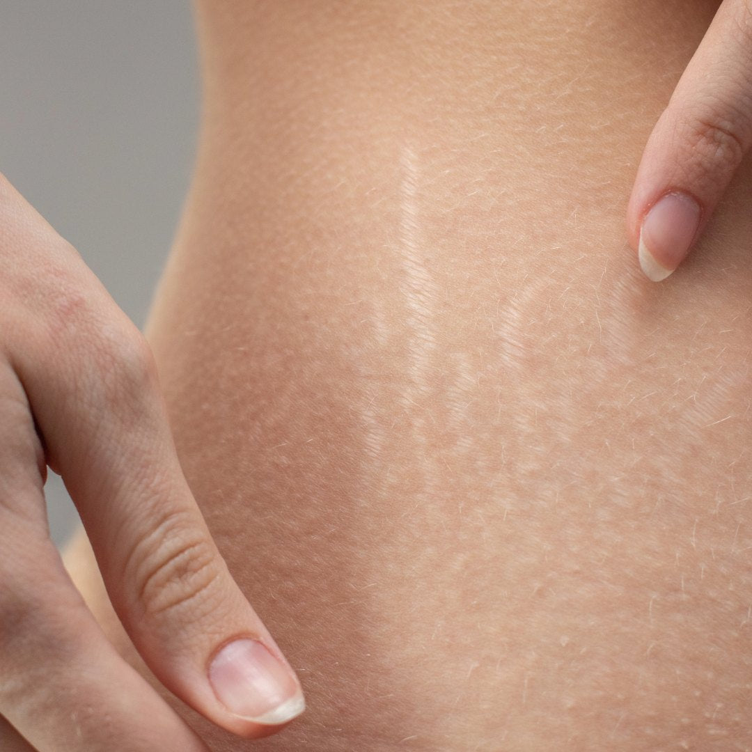 Stretch Mark Removal