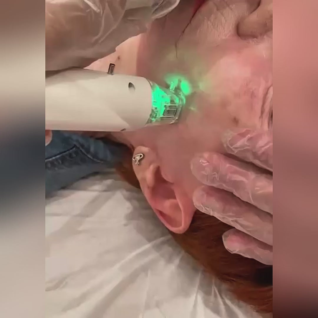 Radiofrequency Microneedling Face