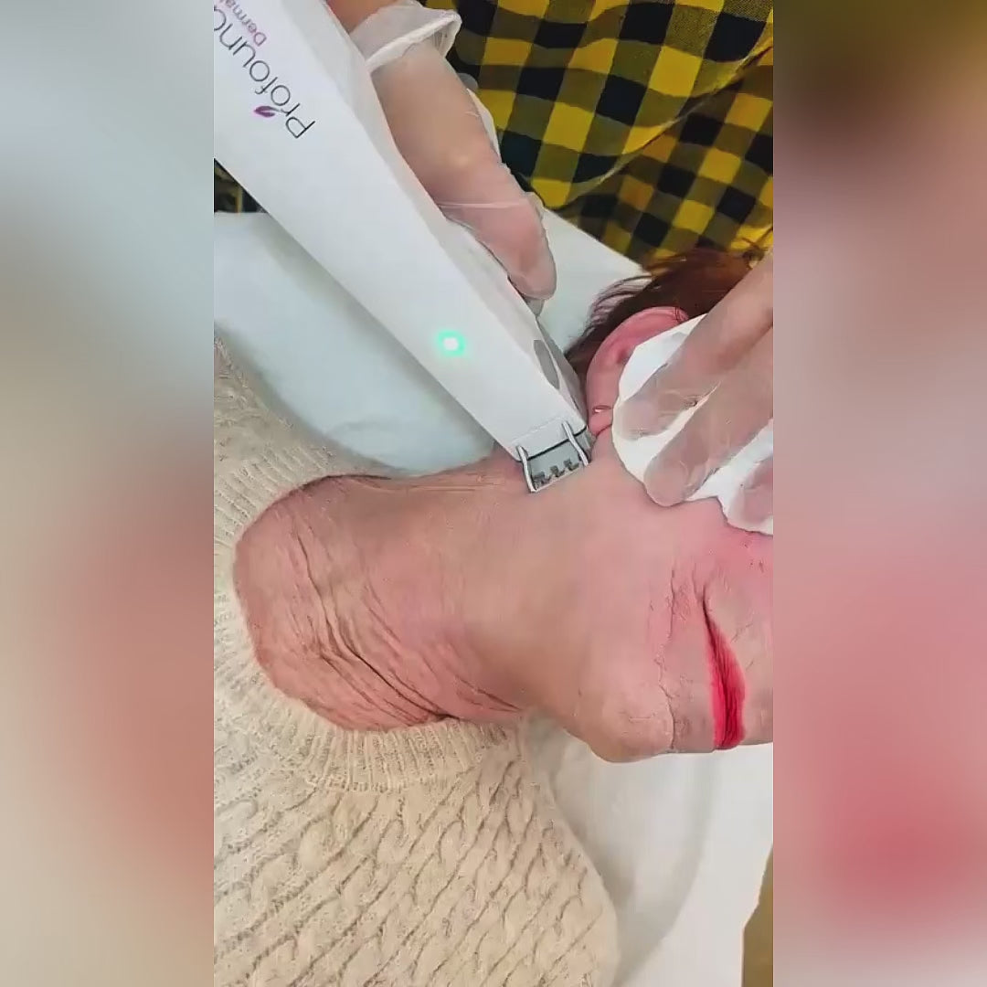 Profound RF Microneedling