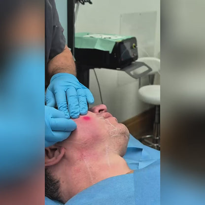 Endolift -