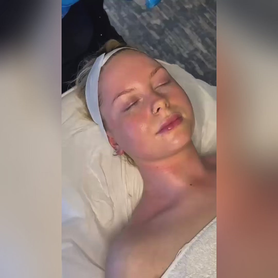 VI Skin Peel